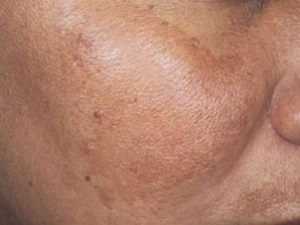 Use GLOW skin lightening solutions to reduce Melasma patches on your face