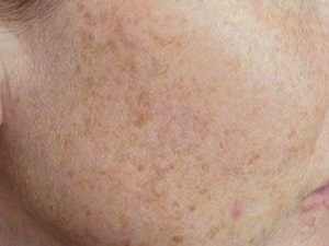 Use GLOW's natural whitening cream to reduce age and sun spots from your face, arms and hands