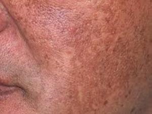 If you suffer from hyperpigmentation, order GLOW skin whitening cream to see fast results