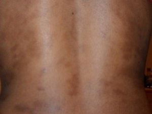 GLOW skin whitening cream is very effective in reducing dark patches on your body