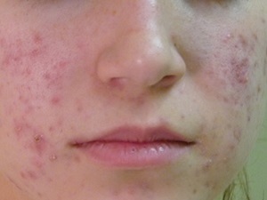 Don't let acne and pimple attacks let you down! GLOW skin whitening cream will help you clear your face quickly