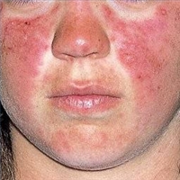 The nasty effects of chemical skin whitening products